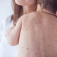 Crema Antihístaminica Allergy