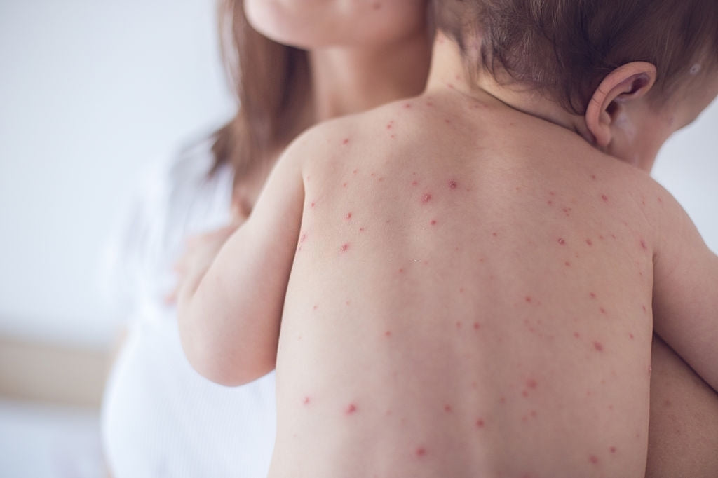 Crema Antihístaminica Allergy