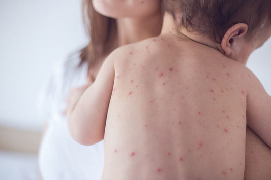 Crema Antihístaminica Allergy